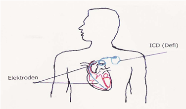 Skizze: Der Defi im Körper